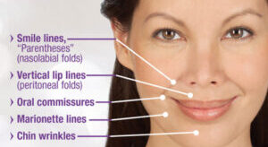 get rid or smile lines: wrinkles around the mouth